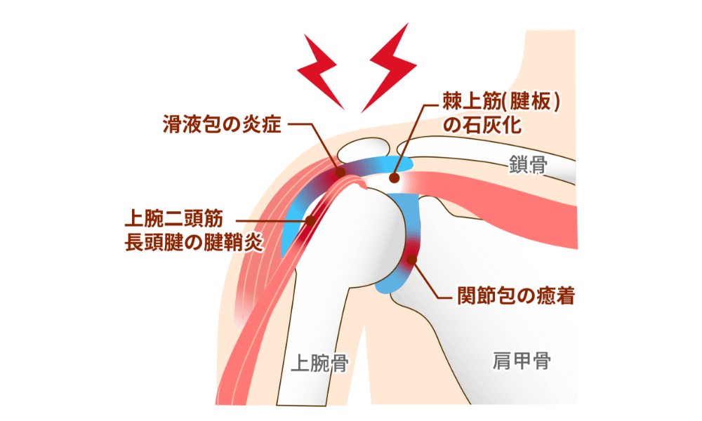 肩関節周囲炎の図