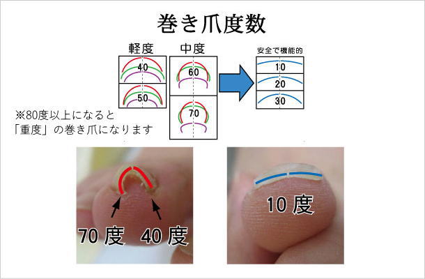 巻き爪料金表 春日部せんげん台たろう保健整骨院