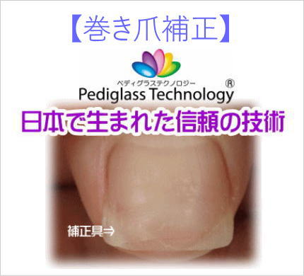 巻き爪補正