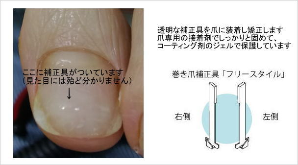 巻き爪の補正具