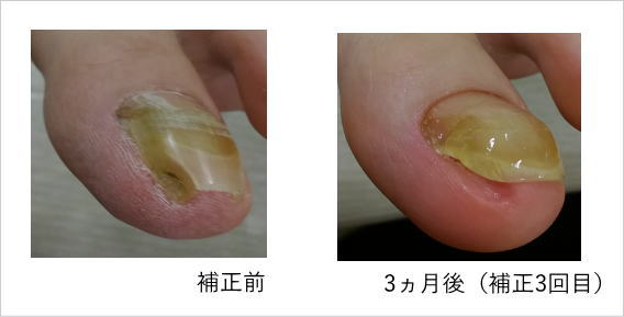巻き爪症例