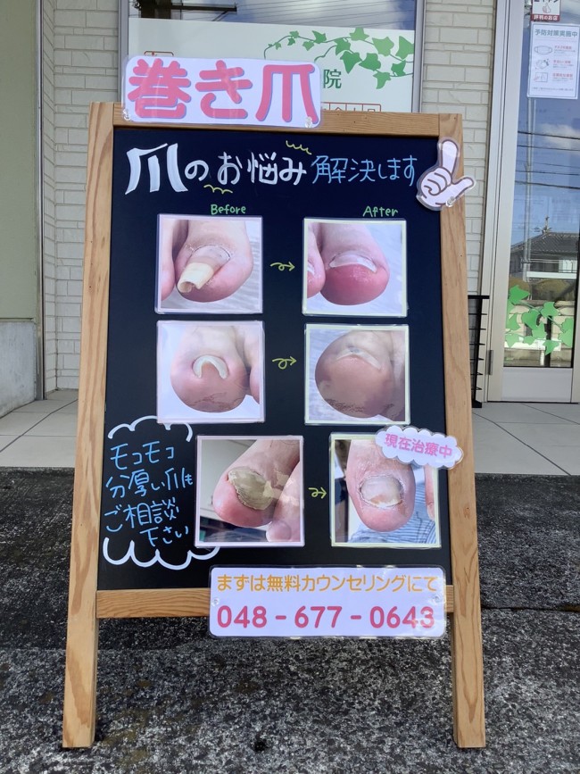 巻き爪の看板