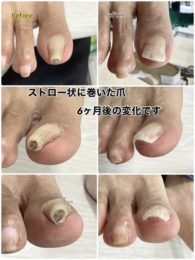 巻き爪重症画像