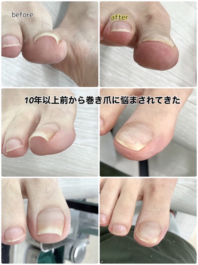 10年以上の巻き爪