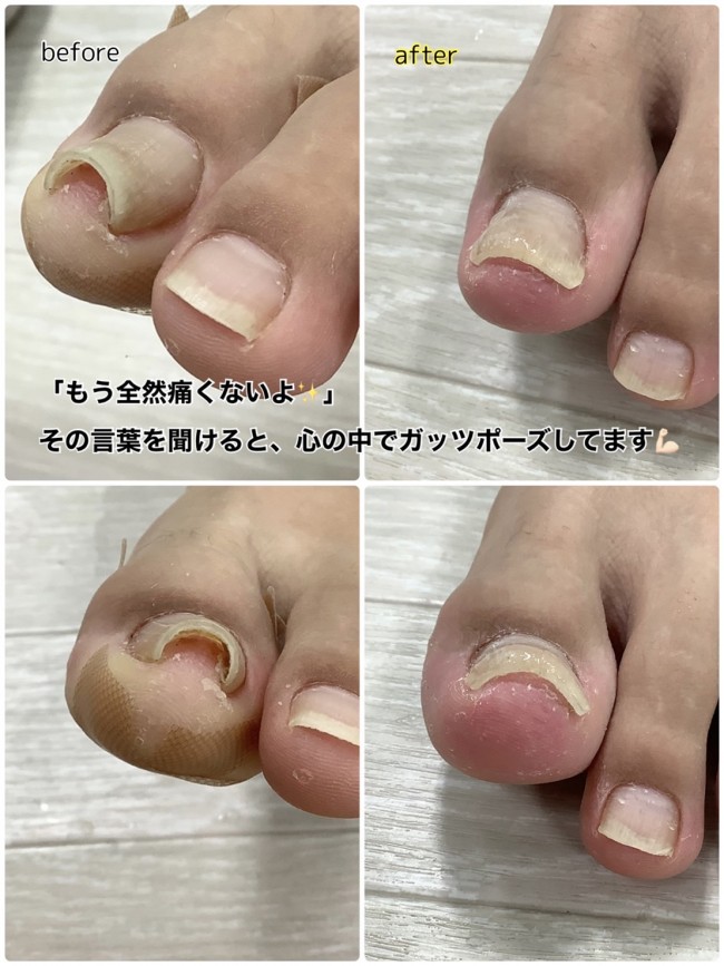 巻き爪改善