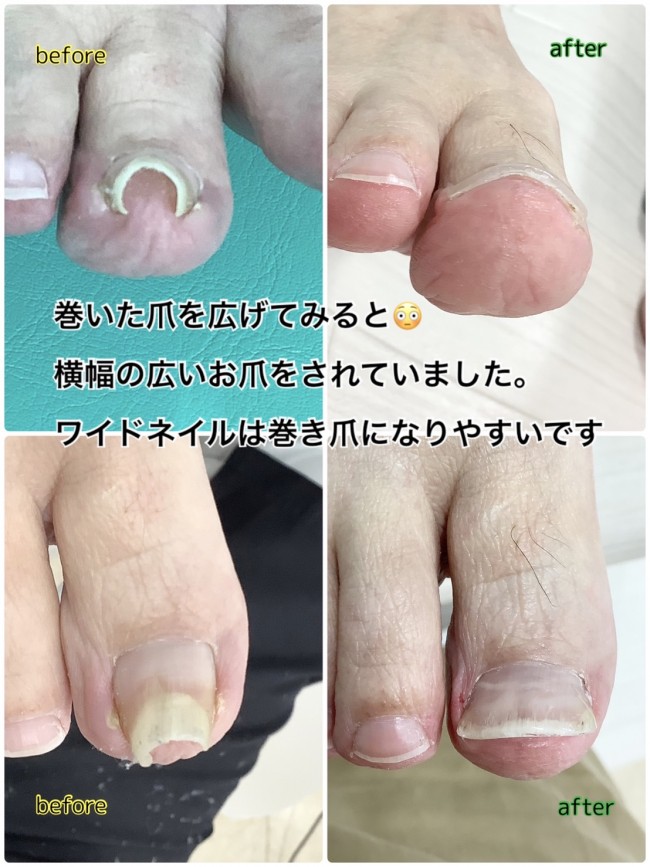 巻き爪症例画像