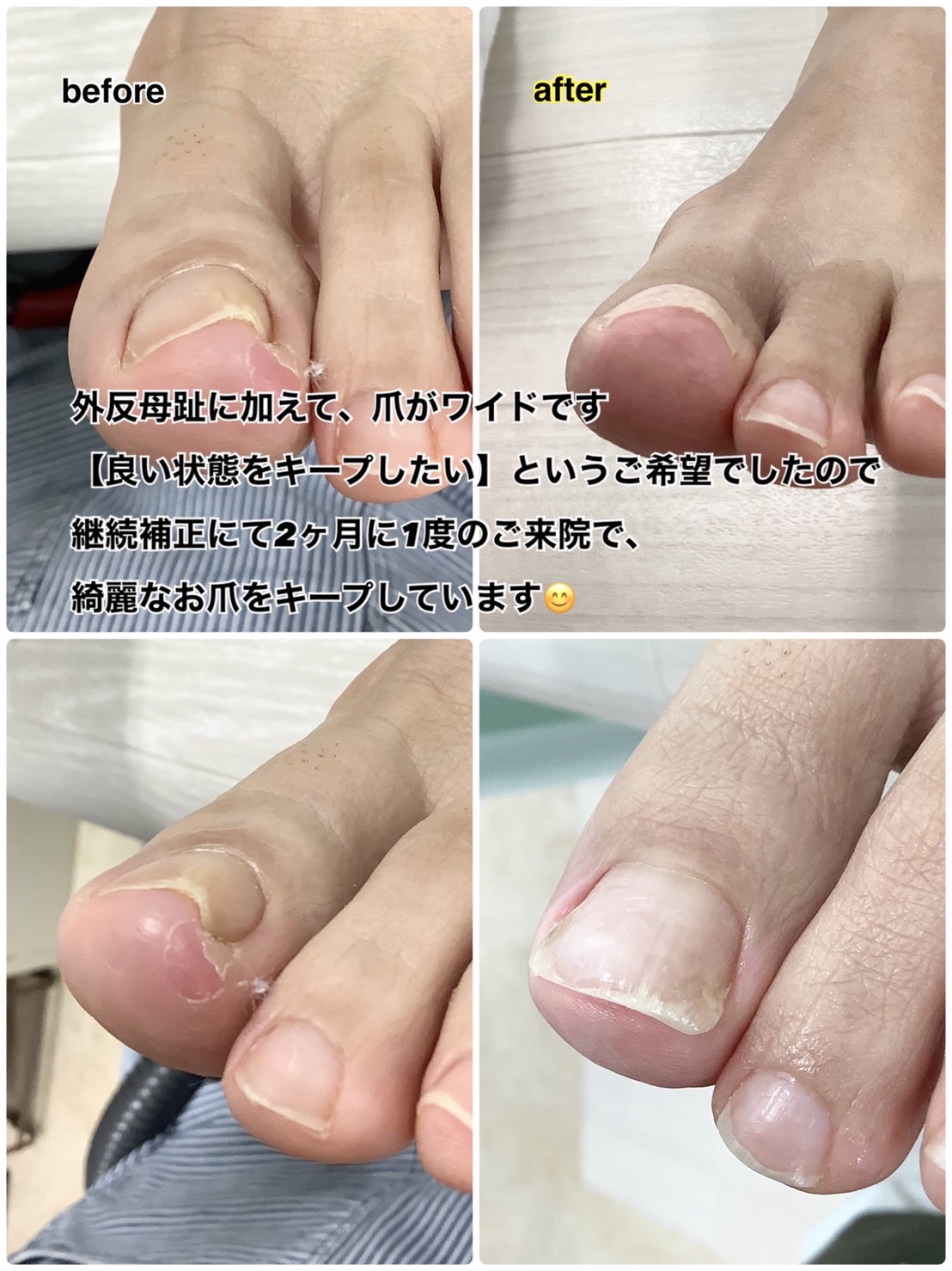 巻き爪症例画像