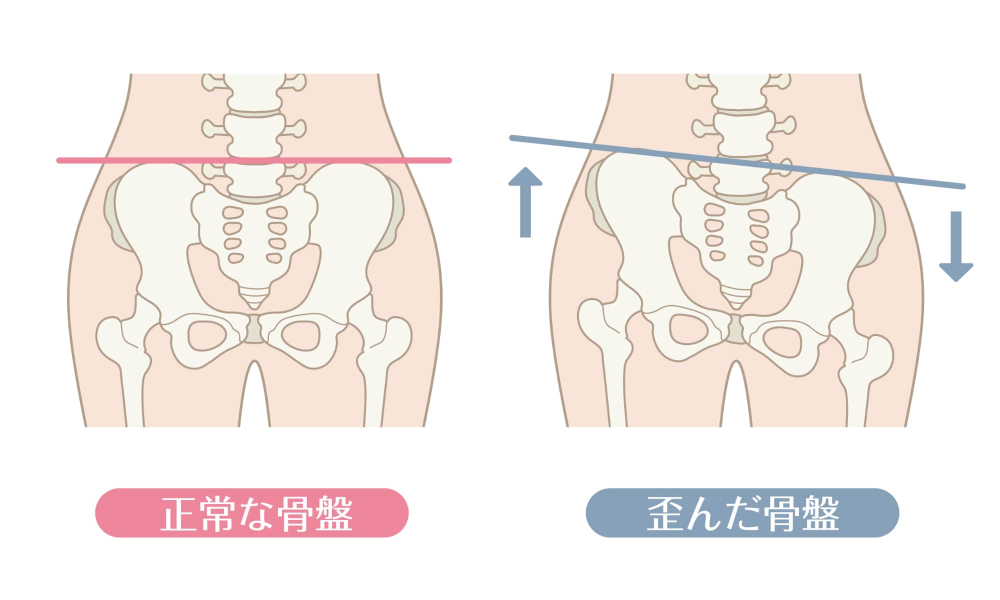 産後の歪んだ骨盤