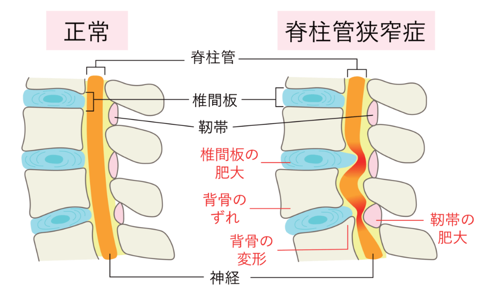 脊柱管狭窄症と正常な脊柱管の比較図