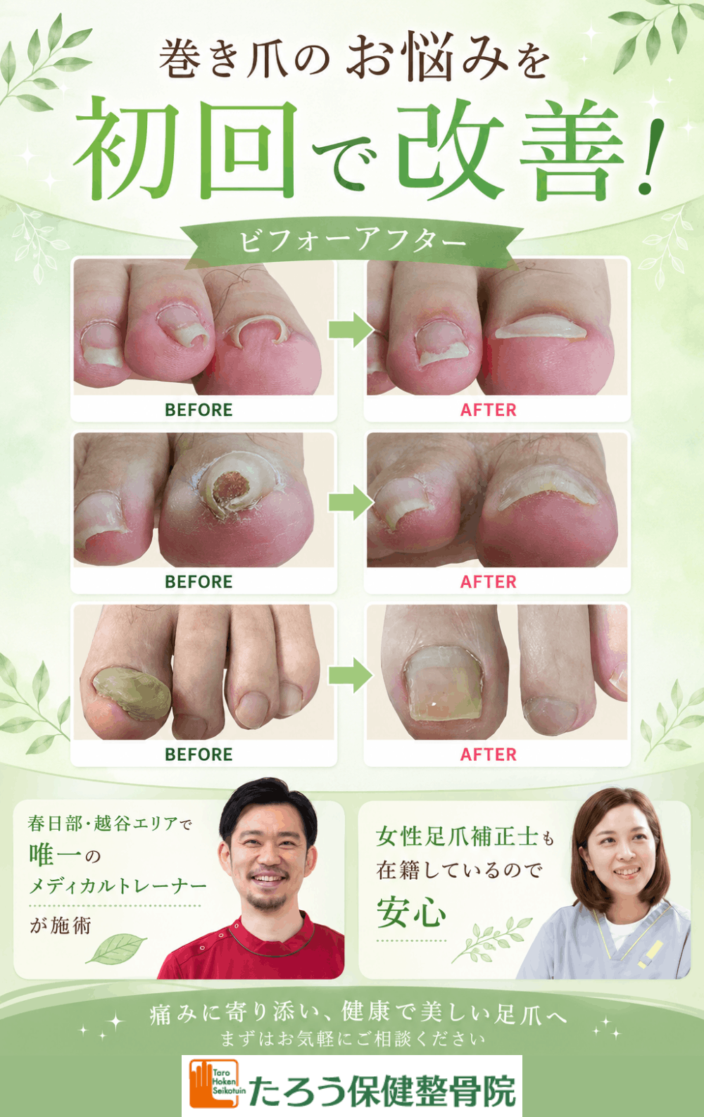 巻き爪補正(ペディグラステクノロジー)｜春日部市たろう保健整骨院