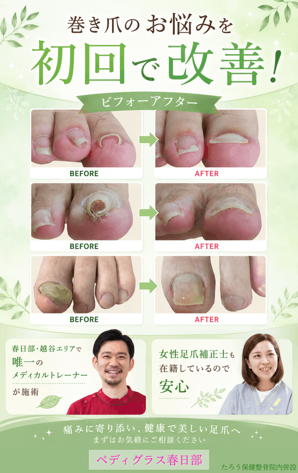 さわこさん専用　　　ペディグラスニュースタンダードスタイル　巻き爪 巻き爪補正(ペディグラステクノロジー)｜春日部市たろう保健整骨院
